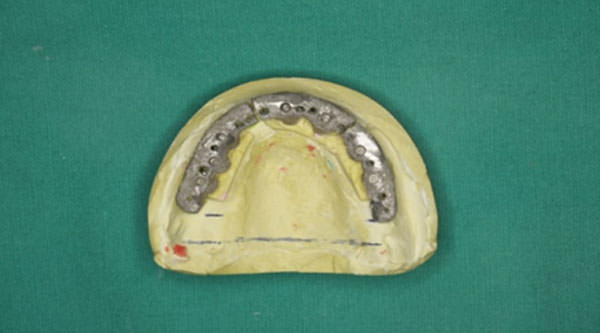 Fig.13 Barra segmentada en Niquel-Cromo.