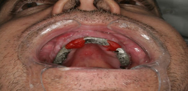 Fig. 14 Vista oclusal del soldaje con Duralay (Polidental) en la boca.
