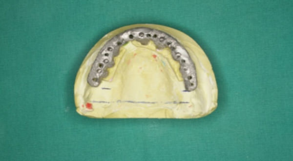 Fig. 15 Barra en monobloque ya fundida.