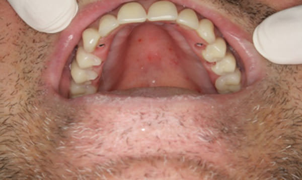 Fig.16 Vista oclusal de la prótesis total fija definitiva atornillada a los mini pilares cónicos.