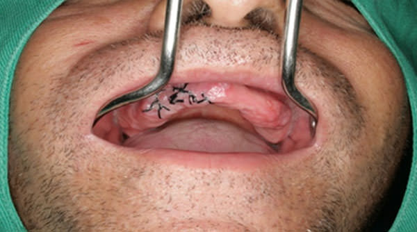 Fig.2 Sutura del área operada.