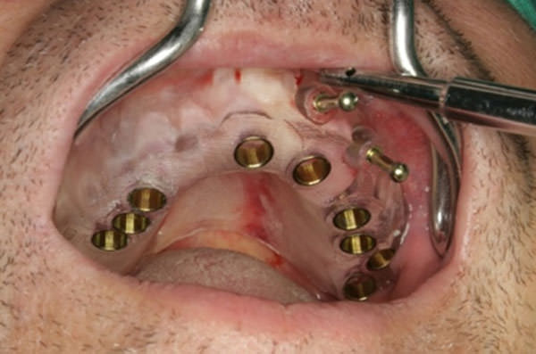 Fig.4 Guía quirúrgica prototipo en posición y estabilizada con tornillos para injerto.