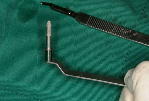 Fig.6 Implante CM listo para su colocación