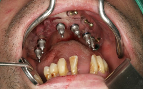 Fig.7 Vista oclusal de los implantes colocados con el uso de la guía prototipo.
