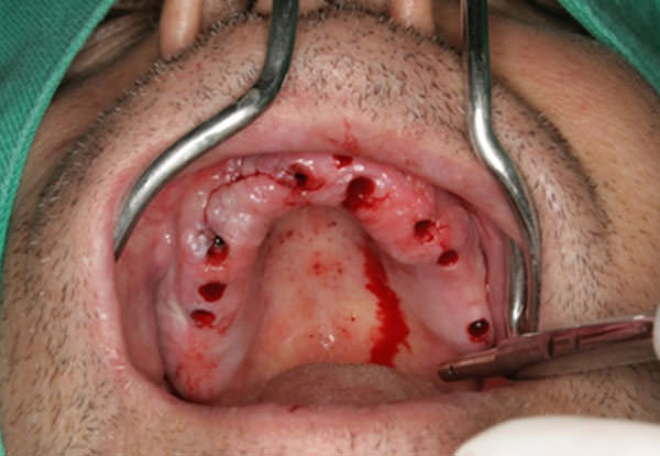 Fig.8 Vista oclusal de las perforaciones realizadas con la guía prototipo.