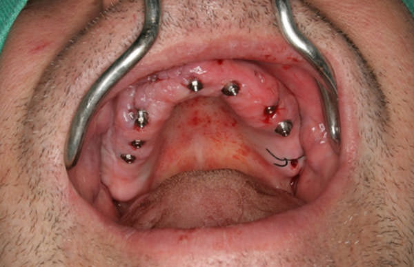 Fig.9 Vista oclusal con los minipilares CM (Neodent. Curitiba-Brasil) en posición.