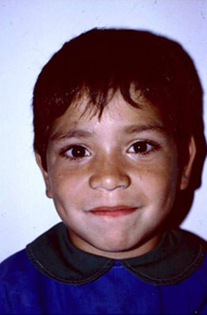 Fig.1 Paciente 4 años