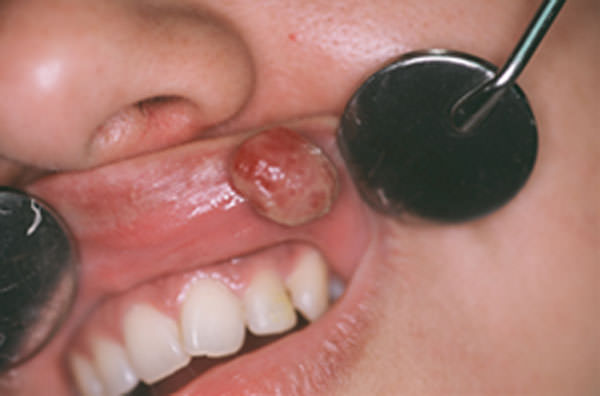 Fig.3 Aspecto clínico de la lesión