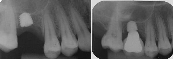 Foto 7 Radiografías control 6 y 12 meses después de su instalación