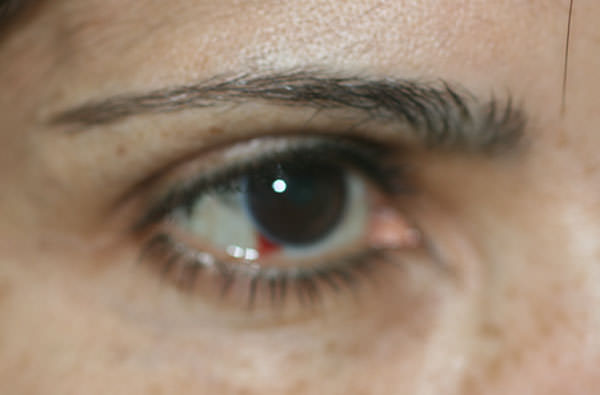 Fig 3 La paciente refiere globo ocular derecho ,enrojecido, brillante, húmedo, con dolor para lo cual utilizó Voltaren® en gotas oftálmico presentando leve mejoría.