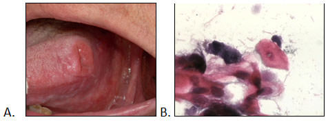 Figura. 1 A. Lesión de cáncer de paciente de 48 años, género femenino. B. Citología exfoliativa de la lesión (H/E 400x).