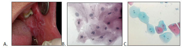 Figura 2: A. Lesión de leucoplasia de 40 años, género masculino. B. Citología exfoliativa de la lesión (H/E, 400x).C. Citología exfoliativa del lado opuesto a la lesión (PAP , 200x)