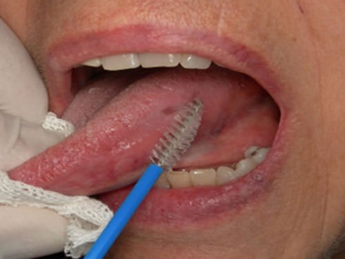 Figura 3: Citología exfoliativa realizada con cepillo colector citológico cytobrush (Medibrush®, Medical Engineering, Buenos Aires, Argentina).