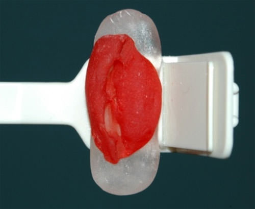 Fig. 2 Paralelizador radiográfico modificado mediante un posicionador de acrílico atornillado a su base e individualizado mediante un registro oclusal con acrílico.