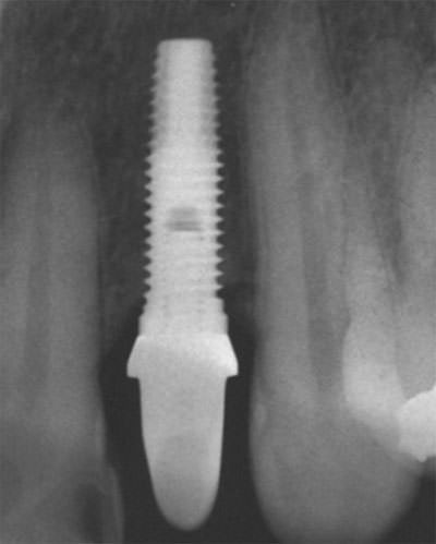 Fig. 4 Radiografía periapical de implante Restore® ubicado en zona de pieza 22.