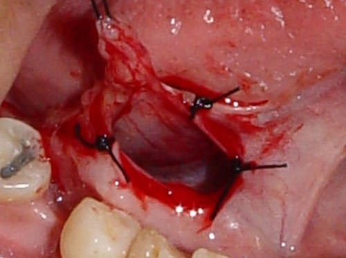 Figura 2 Incisión del primero tercio de la cápsula junto a la sutura de la mucosa del suelo de la boca con el revestimiento quístico