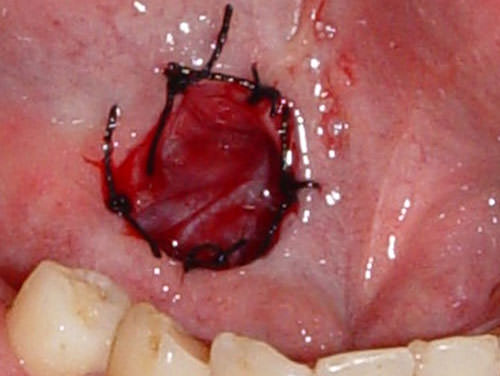 Figura 3 Final de a sutura de la mucosa.