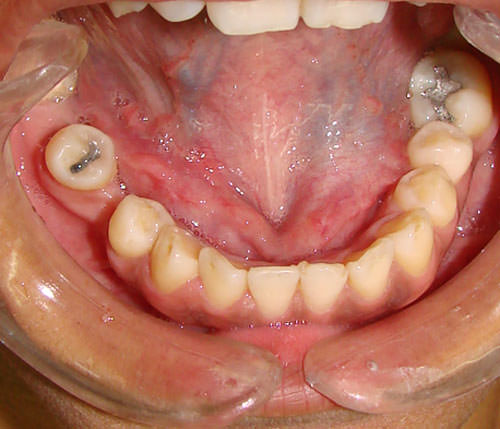 Figura 5 Postoperatorio período de un año.