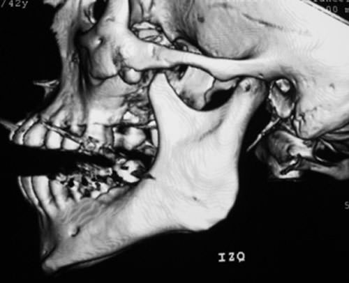 3D BN lateral derecho
