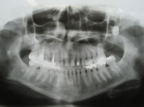Radiografía Panorámica