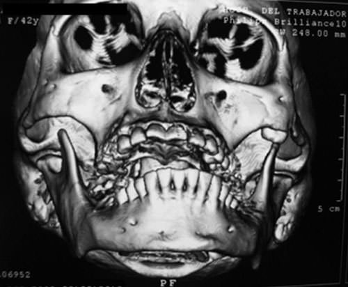 3 D Frontal
