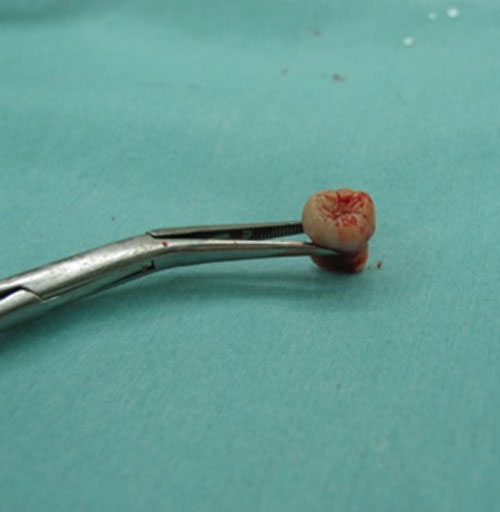 Tercer molar