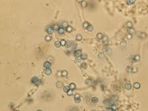 Figura 1 Presencia de hifas la presencia de hifas con abundantes clamidoconidias sugerentes de ser C. dubliniensis.