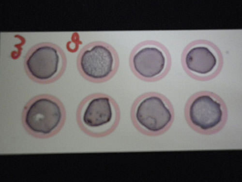Figura 4 Reacción positiva (CP) de colonia de C. dubliniensis a la prueba de aglutinación con látex. Nótese la formación de un halo oscuro periférico conteniendo la mezcla aglutinada.