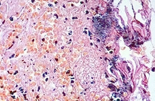 Figura 2 Infiltrado inflamatorio consistió en las células polimórficas, con la proliferación de fibroblastos y numerosos vasos sanguíneos. Mostraron los canales vasculares delgadas paredes cubiertas con tejido epitelial, con algunas zonas ulceradas cubiertas de fibrina.