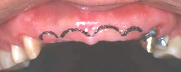 Figura 3 Áreas edéntulas con arco cóncavo gingival diseñado