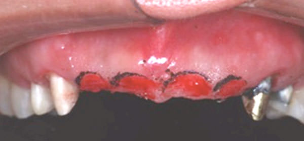 Figura 5 Mucosa Queratinizada Escarificada