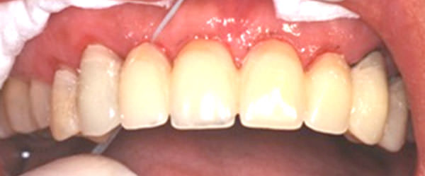 Figura 8 Pasaje del hilo dental en el área de los pónticos, para probar la presión ejercida Figura 9_ Vista de perfil de las restauraciones provisionales. Observar la integración con los tejidos