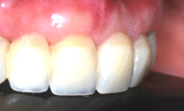 Figura 9 Vista de perfil de las restauraciones provisionales. Observar la integración con los tejidos gingivales