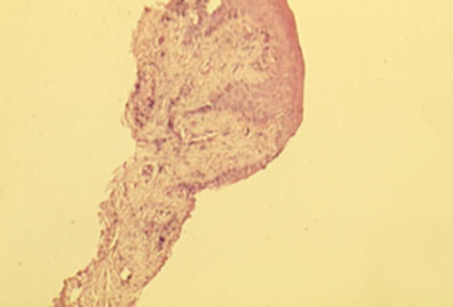 Figura 4 Aspecto histopatológico