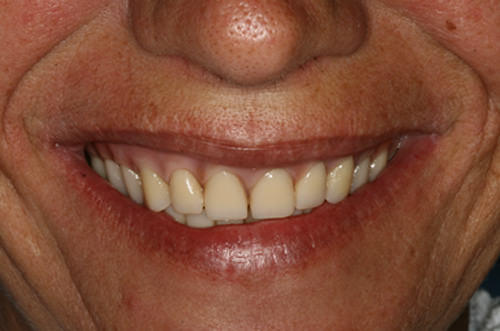 Fig 1 Sonrisa de la paciente con prótesis insatisfactoria