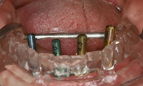 Fig 12 Uso de la guía mulfuncional y paralelómetro para comprobar la posición de los implantes