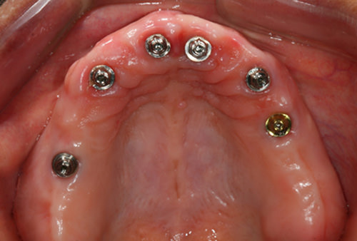 Fig 13 Los implantes colocados en la arcada superior y los pilares del tipo de mini pilares cónicos.