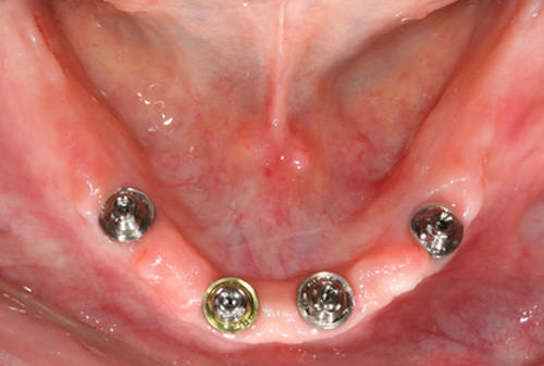 Fig 14 Los implantes colocados en la arcada inferior y los pilares del tipo de mini pilares cónicos