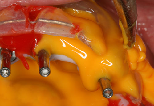 Fig 16 Inyección de silicona por condensación fluida para la transferencia de los implantes