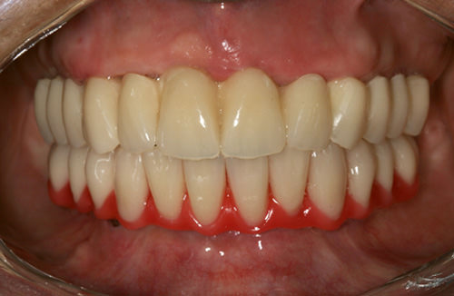Fig 19 Prueba de la prótesis sobre implantes con dientes montados en cera