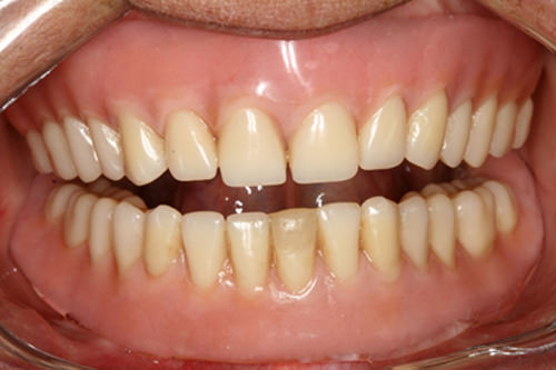 Fig 2 Vista frontal de las dentaduras insatisfactoria