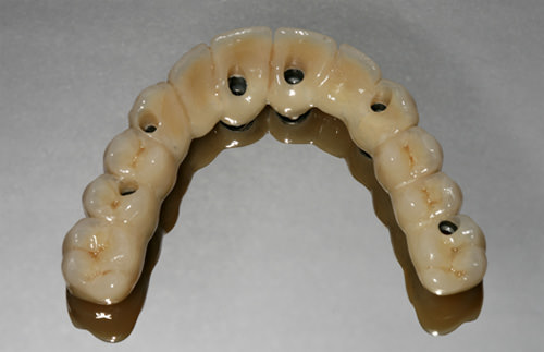 Fig 21 Vista oclusal de la prótesis superior