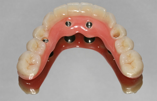 Fig 22 Vista oclusal de la prótesis inferior