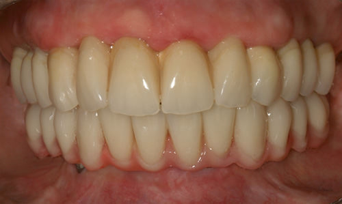 Fig 23 Vista frontal de la prótesis sobre implantes