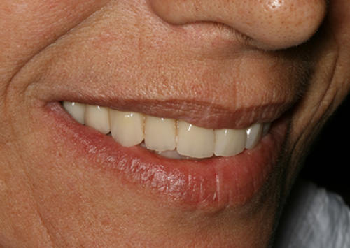 Fig 24 Sonrisa del paciente después de la rehabilitación