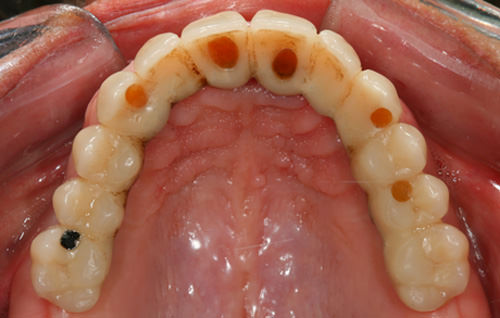 Fig 25 Vista oclusal de la prótesis superior a los 20 meses de uso