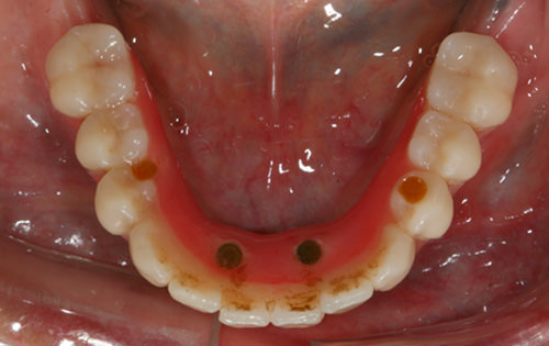 Fig 26 Vista oclusal de la prótesis inferior a los 20 meses de uso