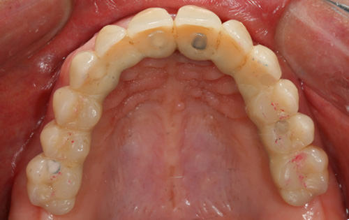 Fig 27 Vista oclusal de la prótesis superior pulida y eliminadas las manchas nicotínicas