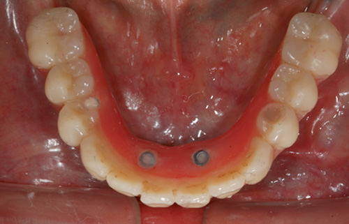 Fig 28 Vista oclusal de la prótesis inferior después de pulir para eliminar las manchas nicotínicas