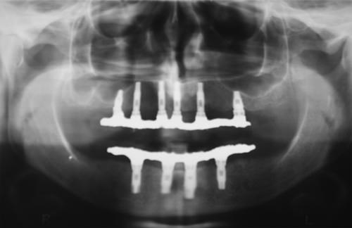 Fig 29 Radiografía panorámica de 20 meses de seguimiento
